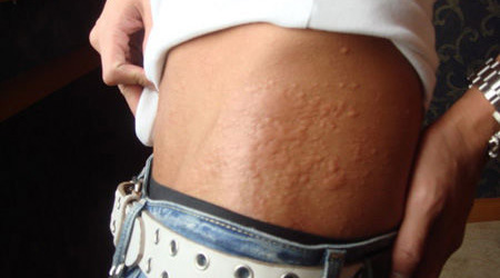 Виды аллергии на коже у взрослых