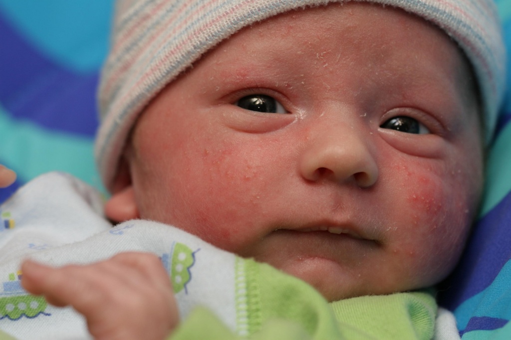 Акне новорожденных – причины, признаки, лечение