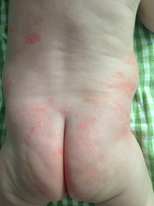 Аллергическая сыпь у детей - лечение в Зеленограде — медцентр АКСИС