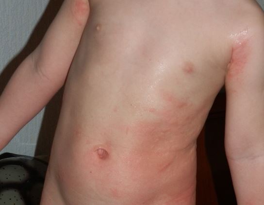 Пищевая аллергия у грудных детей: симптомы и лечение