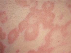 Аллергическая сыпь на лице и теле - причины и лечение