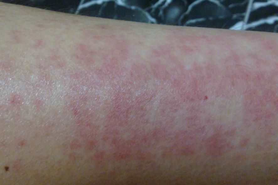 Фото аллергии на коже лица и рук