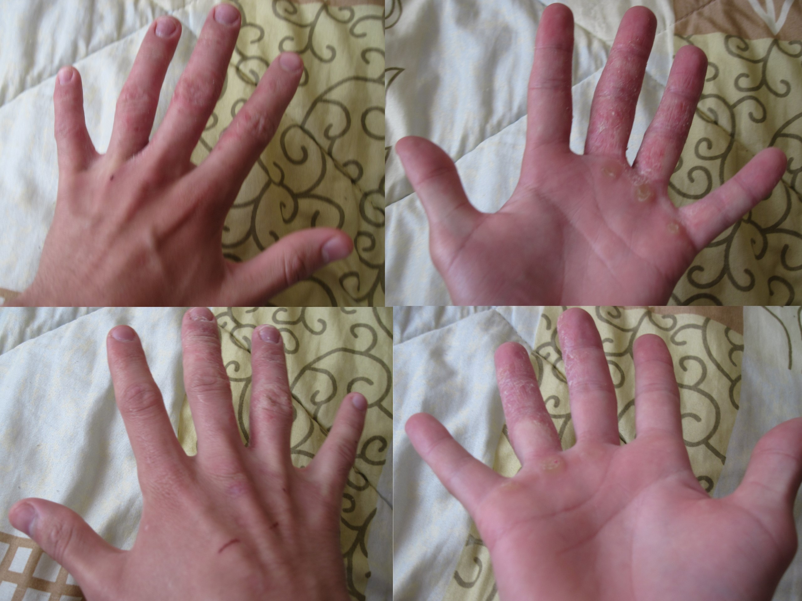 Воспаление кожи вокруг ногтя на руке