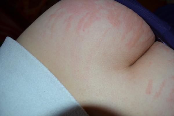 Фото аллергии на коже лица и рук
