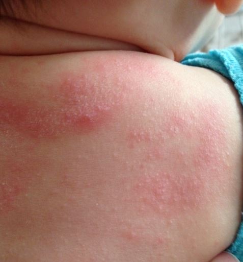 Почему возникает аллергия на киви: симптомы и причины