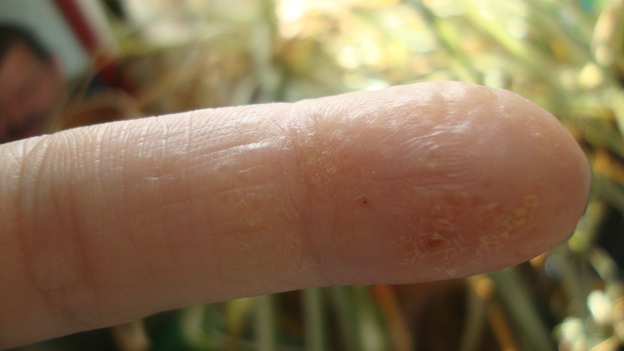 Почему трескается кожа на руках и как легко от этого избавиться?