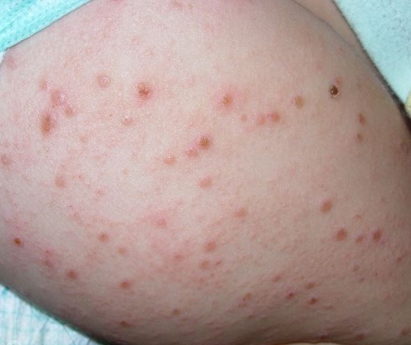 Кожная аллергия: причины и лечение красных пятен