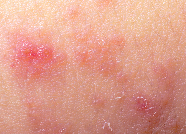 медицина кожные заболевания дерматит thumbnail