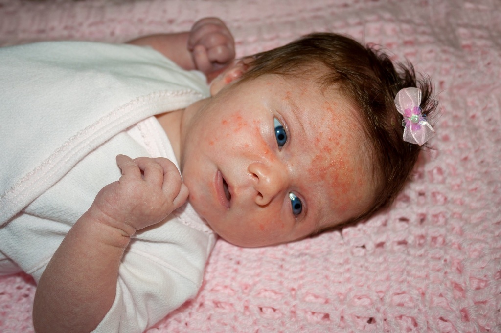 Акне новорожденных – причины, признаки, лечение