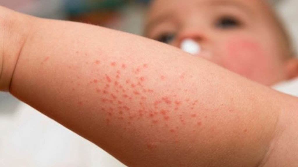 Как отличить потницу от аллергии у ребенка