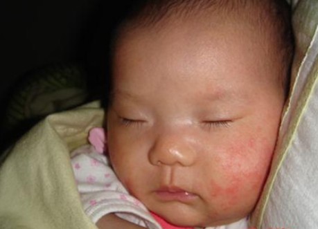 аллергия на щеках у ребенка - фото