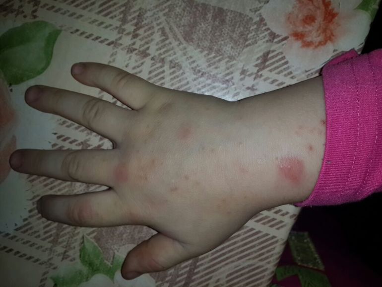 аллергия на укус насекомого - фото