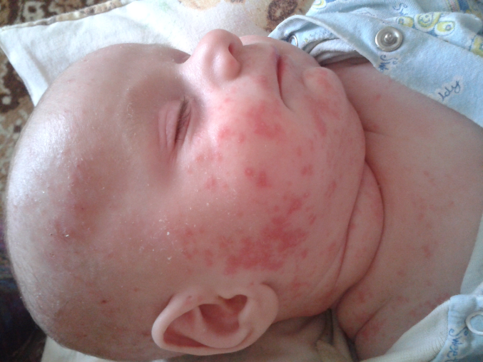 аллергия у детей на щеках