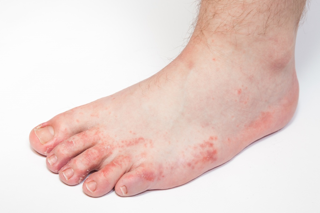 аллергический дерматит на ногах - как выглядит, фото