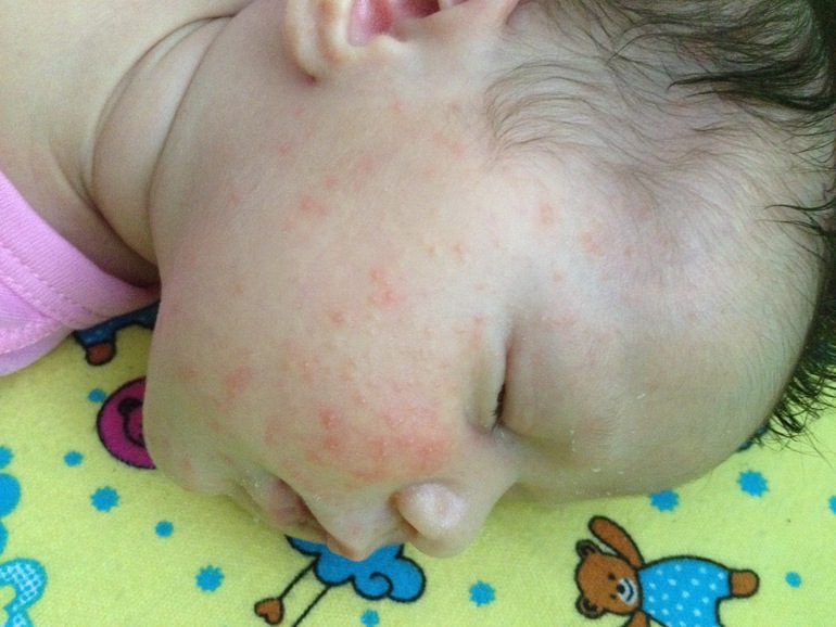На что может быть аллергия у ребенка на щеках thumbnail