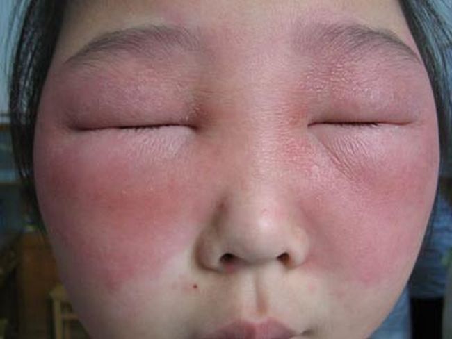 allergia 5 - foto