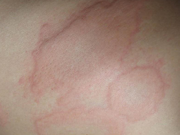 аллергия кожи ребенка