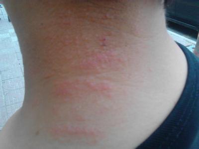 аллергия кожи головы фото