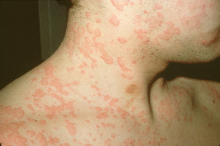 аллергия красные пятна фото