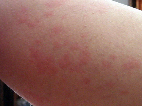 аллергия у детей на руках