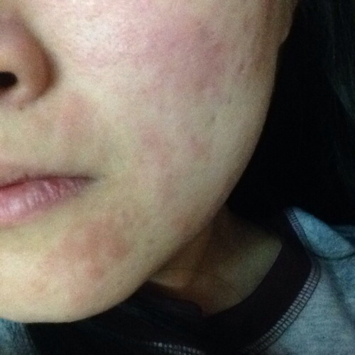 аллергия на лице фото