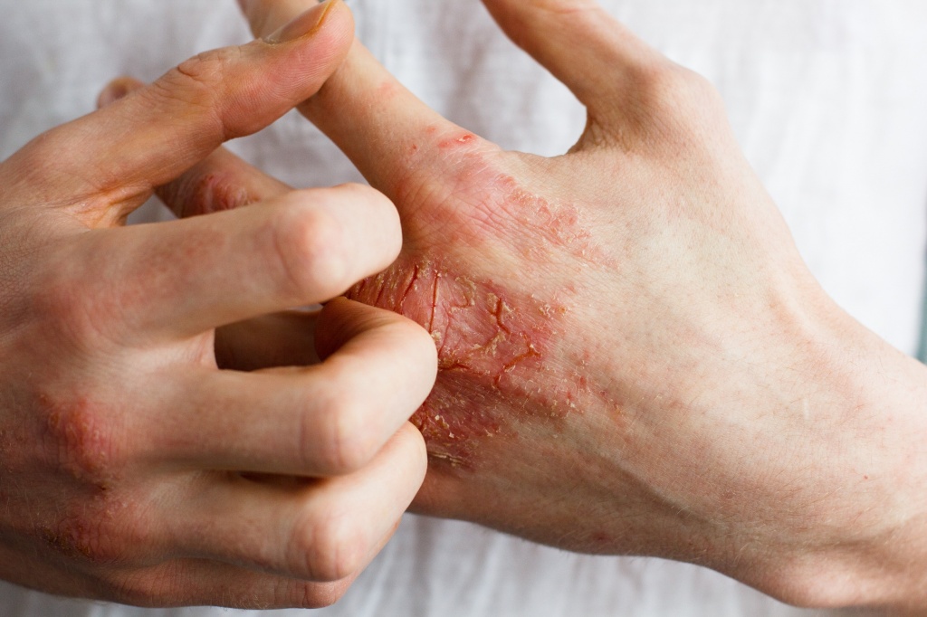 Лечение авитаминоза кожи рук thumbnail