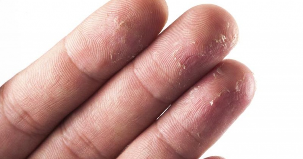 Треснутая кожа на руках: профилактика и решение проблемы