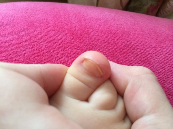 Пальцы ног ребенка при авитаминозе, фото 