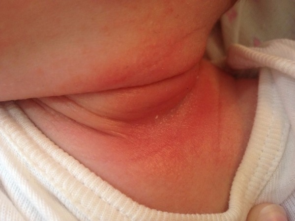 Опрелости у новорожденного в складках шеи, фото 