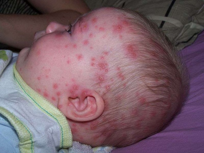 фото сыпи при инфекционных заболеваниях у детей