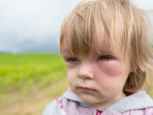 Аллергический отек на лице у ребенка, фото