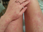 Аллергия на руках у взрослого человека, фото