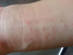 Аллергия от стирального порошка - фотография, фото