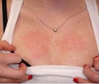 аллергия на груди: причины и лечение