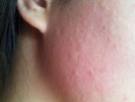 Аллергия на щеках на лице, фото, фото