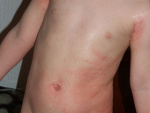 аллергия у ребенка на теле