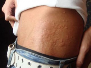 Аллергия на теле у взрослого человека, фото