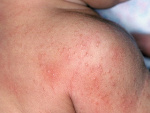 Аллергия на теле у ребенка, фото