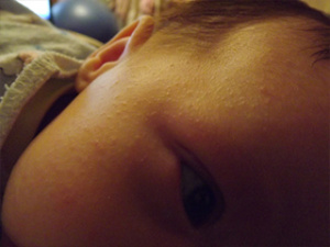 Сыпь на лице у ребенка, фото