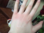 Дерматит аллергический на руке, фото
