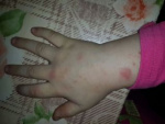 Аллергия от стирального порошка на руке, фото