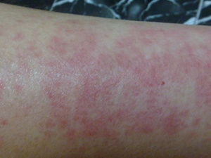 Аллергия на руках, фото