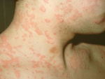 Аллергия на шее у взрослого, фото