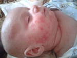 Аллергия на лице у грудного ребенка, фото