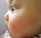 сыпь на щеках у ребенка