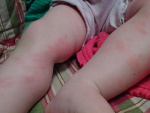 Аллергия на ногах, фото