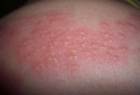 аллергия в виде волдырей на коже – как  и чем лечить?