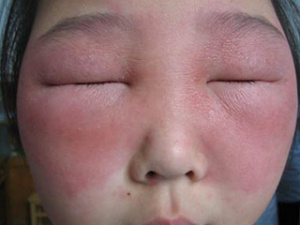 Фотография аллергии на лице, фото