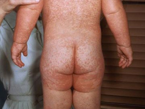 Сыпь на теле у грудного ребенка, фото
