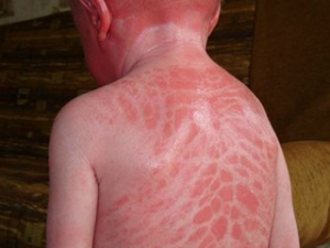 Ихтиоз на спине у ребенка, фото